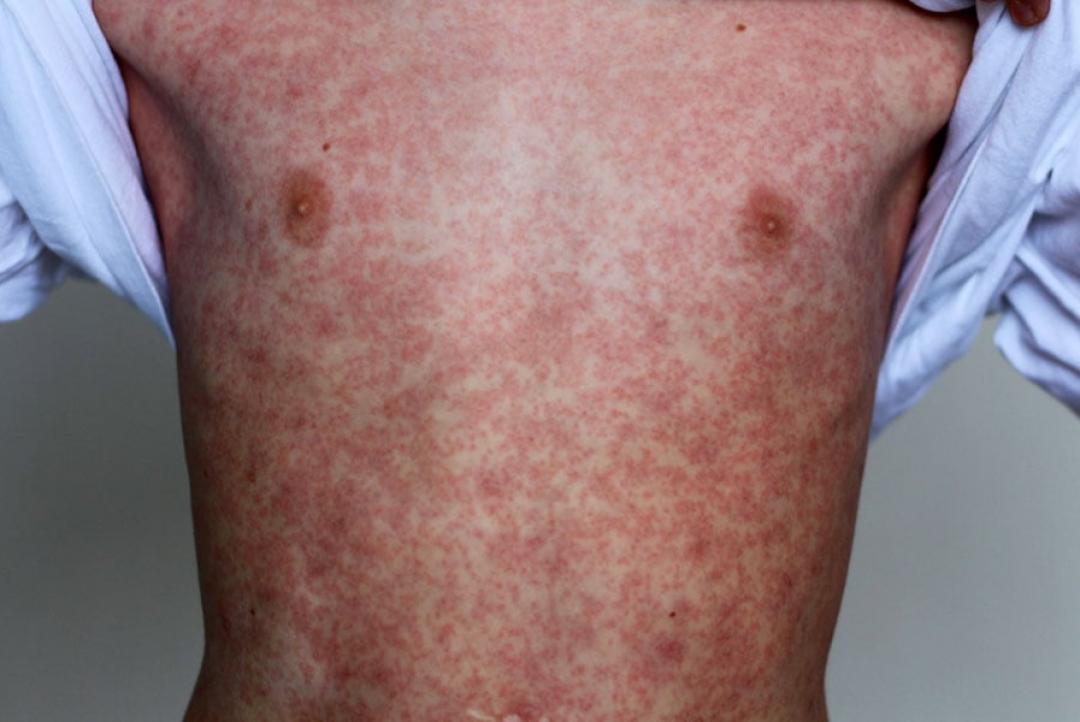 Dois casos de sarampo são confirmados em MT após viagem à Bolívia